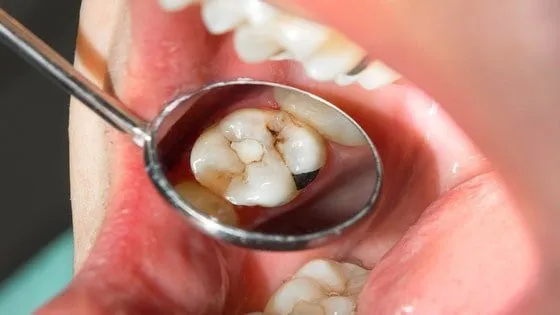 From Teeth to Heart: The Serious Consequences of Untreated Decay