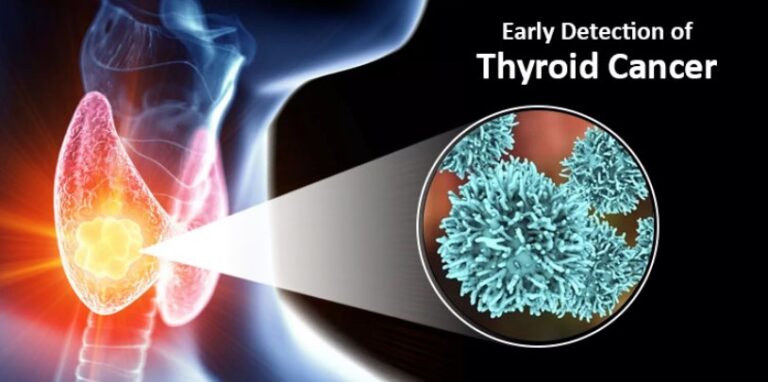 Early Detection of Thyroid Cancer: Diagnose, Fight and Survive